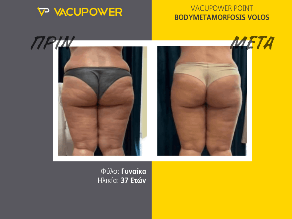 vacupower αποτελέσματα